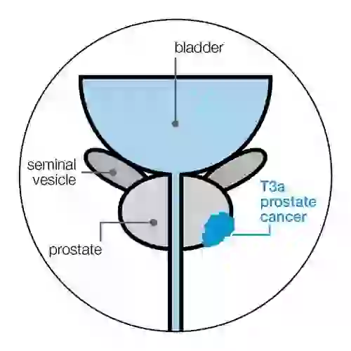 t3a-stage-prostate-cancer