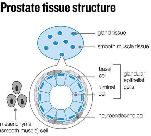 prostate cancer cell types prostatitis és funduk