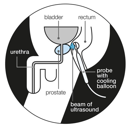 prostate cancer hifu complications)