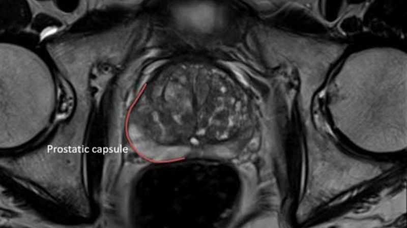 mpMRI before biopsy