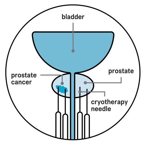A diagram showing a bladder, prostate, prostate cancer and four cryotherapy needles