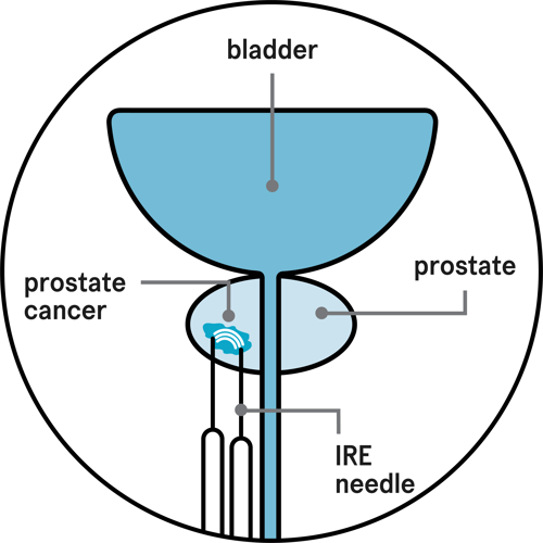 IRE needles inserted in the prostate are releasing a small amount of electricity to treat the cancer.