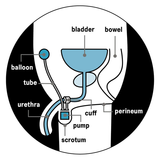 Artificial urinary sphincter