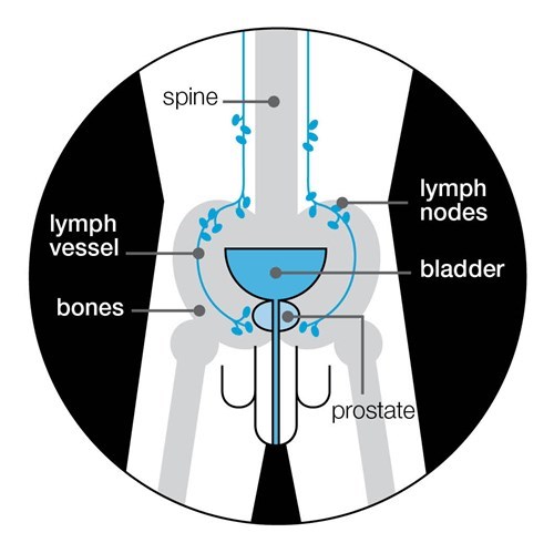 advanced prostate cancer symptoms