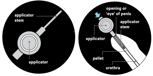 A graphic showing how to use an applicator to insert the pellet into your penis.