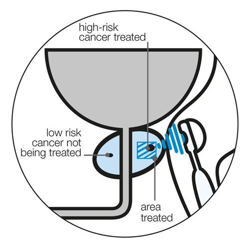 High intensity focused ultrasound HIFU Prostate Cancer UK