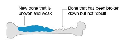 Bisphosphonates In Advanced Prostate Cancer Prostate Cancer Uk