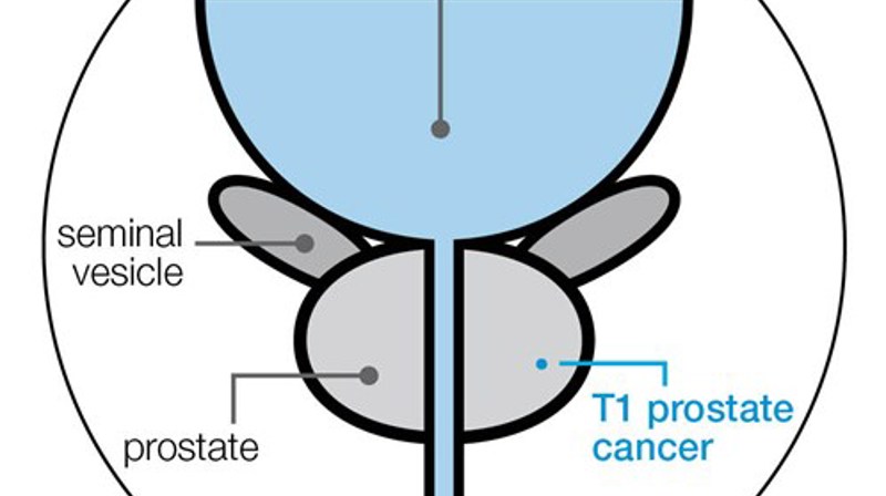 t1-stage-prostate-cancer