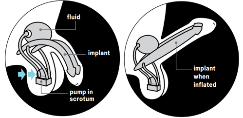 Implants.png