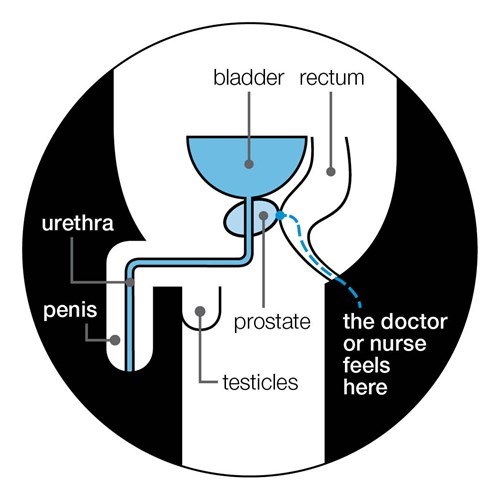 What Is A Prostate Exam Purpose And What To Expect Kienitvcacke