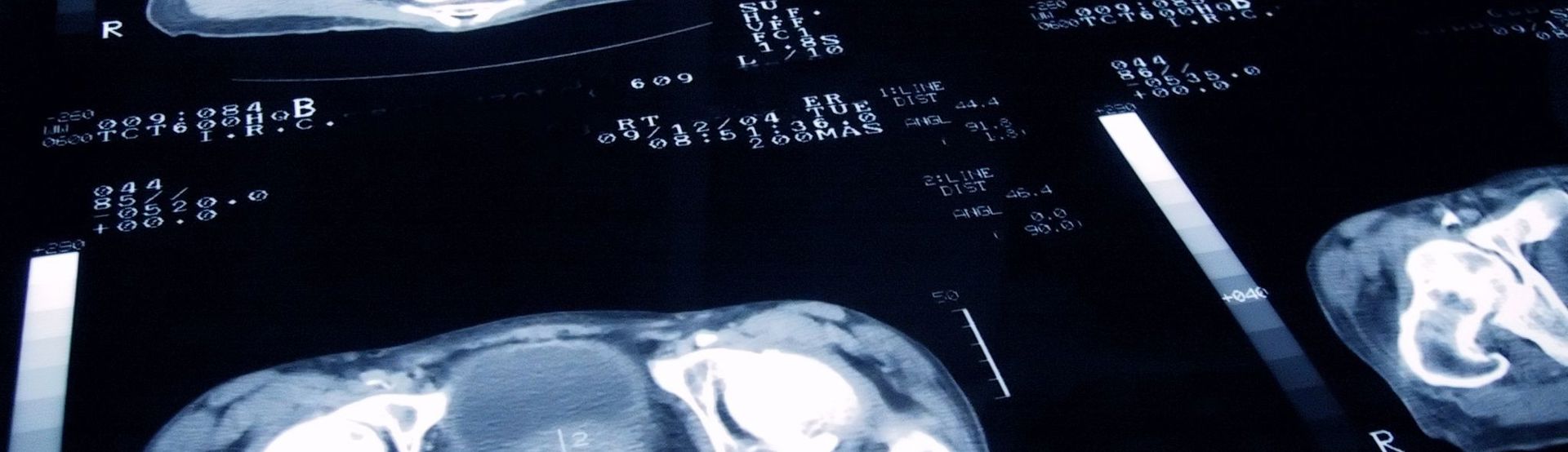 Skynews Prostate Cancer Scan 5853581