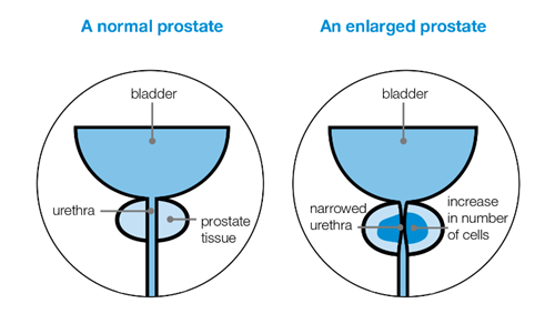 Enlarged prostate Prostate Cancer UK