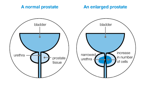 stagnáló prostatitis Mi az