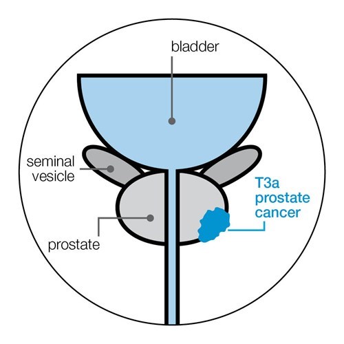 Scans To See If Your Cancer Has Spread Prostate Cancer Uk