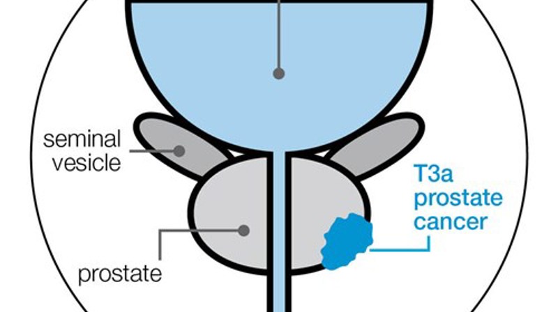 t3a-stage-prostate-cancer