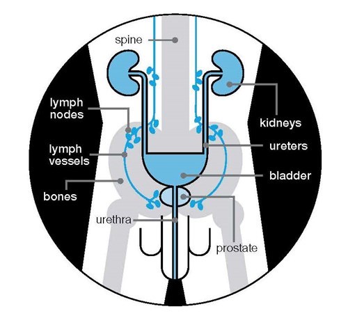 prostate cancer metastasis to bowel sfincterul vezicii urinare