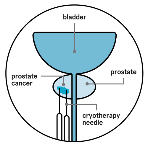 A diagram showing a bladder, prostate, prostate cancer and two cryotherapy needles