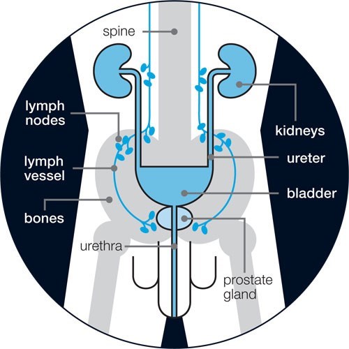 advanced prostate cancer symptoms