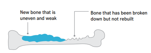Diagram showing the cycle of what happens when cancer spreads to the bone