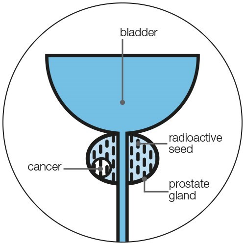 During permanent seed brachytherapy treatment, between 60 and 120 tiny radioactive seeds are placed in the prostate using thin needles.