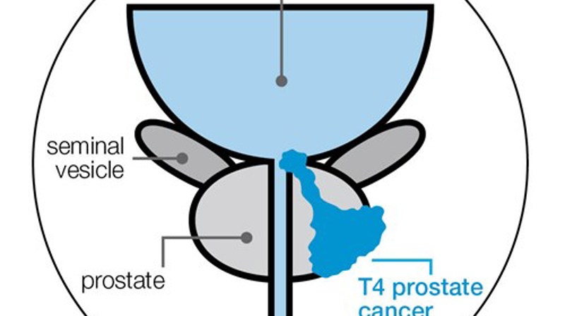 t4-stage-prostate-cancer