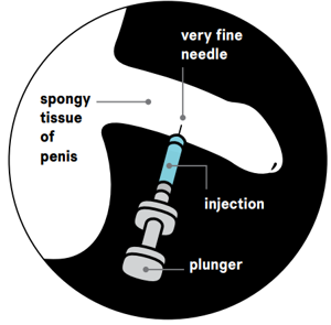 A graphic showing how to administer injections to the penis.