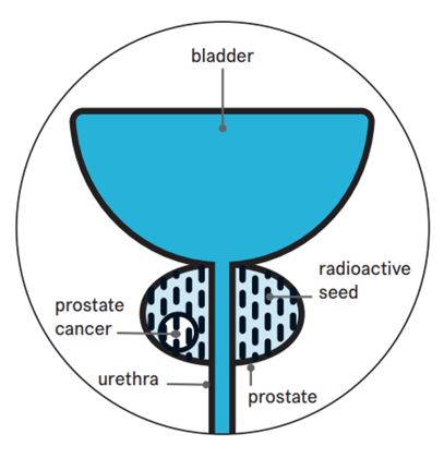 A diagram showing the bladder, prostate and urethra. It highlights a small area of prostate cancer and tiny radioactive seeds placed in the prostate to treat it.