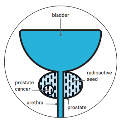 A diagram showing the bladder, prostate and urethra. It highlights a small area of prostate cancer and tiny radioactive seeds placed in the prostate to treat it.