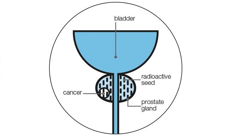 Brachytherapy Where The Seeds Go V4 With Labels Cmyk